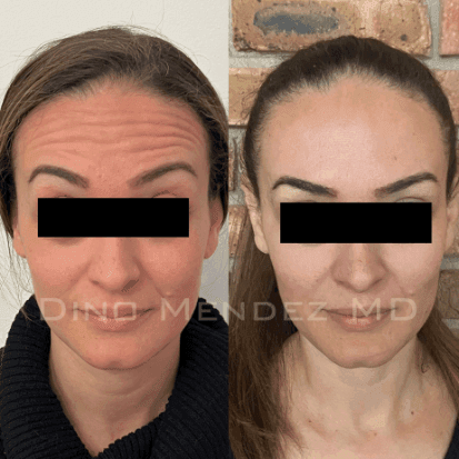 pinnacleskin.com /treatments/botox Carousel 1 Image 4