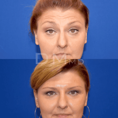 pinnacleskin.com /treatments/botox Carousel 1 Image 8