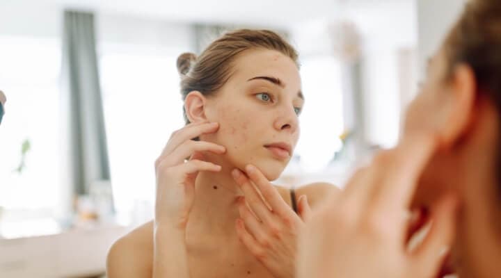 Does Chocolate Really Cause Acne? A Study Reveals New Insights